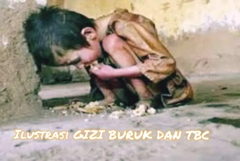 Pasien Gizi Buruk Rentan Menderita TBC, Warga Parungpanjang Bogor Dapat Pengobatan Intensif